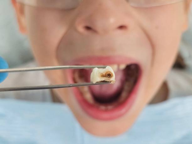 Best Emergency Tooth Extraction in Claremore, OK